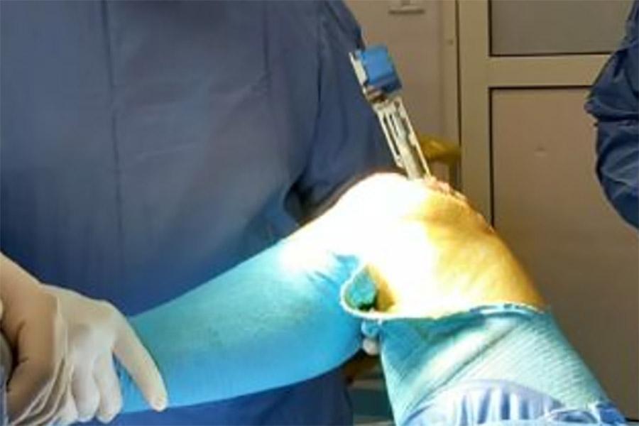 OPERAZIONE GINOCCHIO